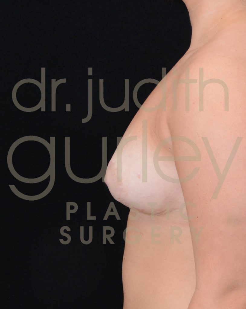 Adolescent breast correction surgery Before and After results
