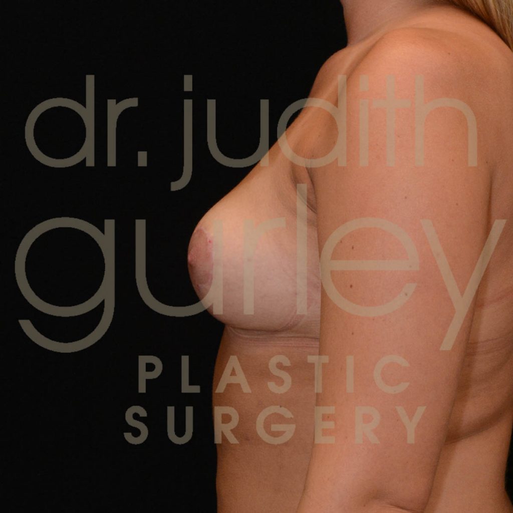 Breast Asymmetry Correction Surgery Before & After Patient # 10160