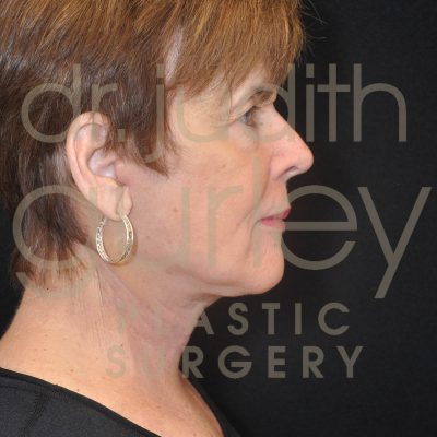 Facial Rejuvenation Plastic Surgery - Before and After by Dr. Gurley Face Lift