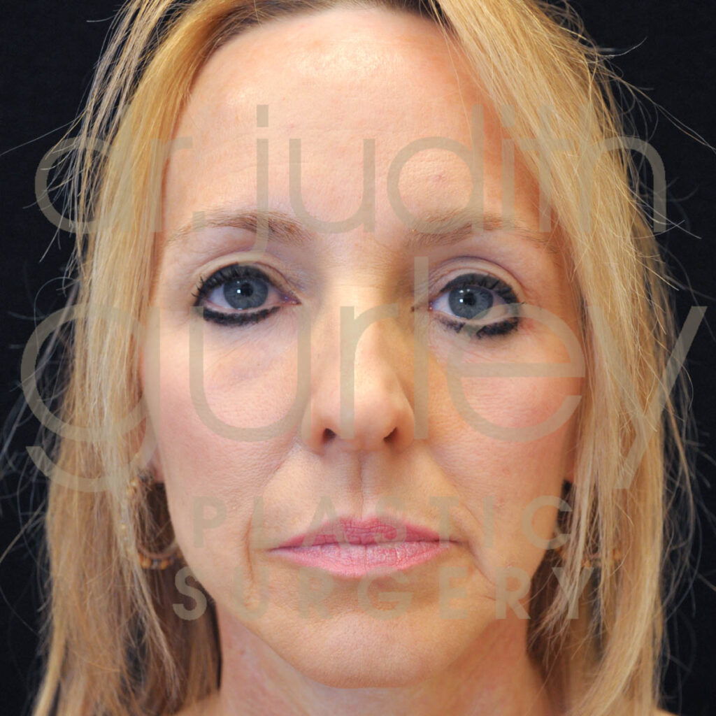 facial-laser-co2-facial-rejuvenation