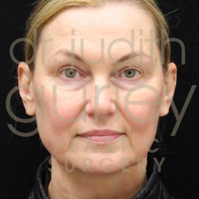 facial filler before and after