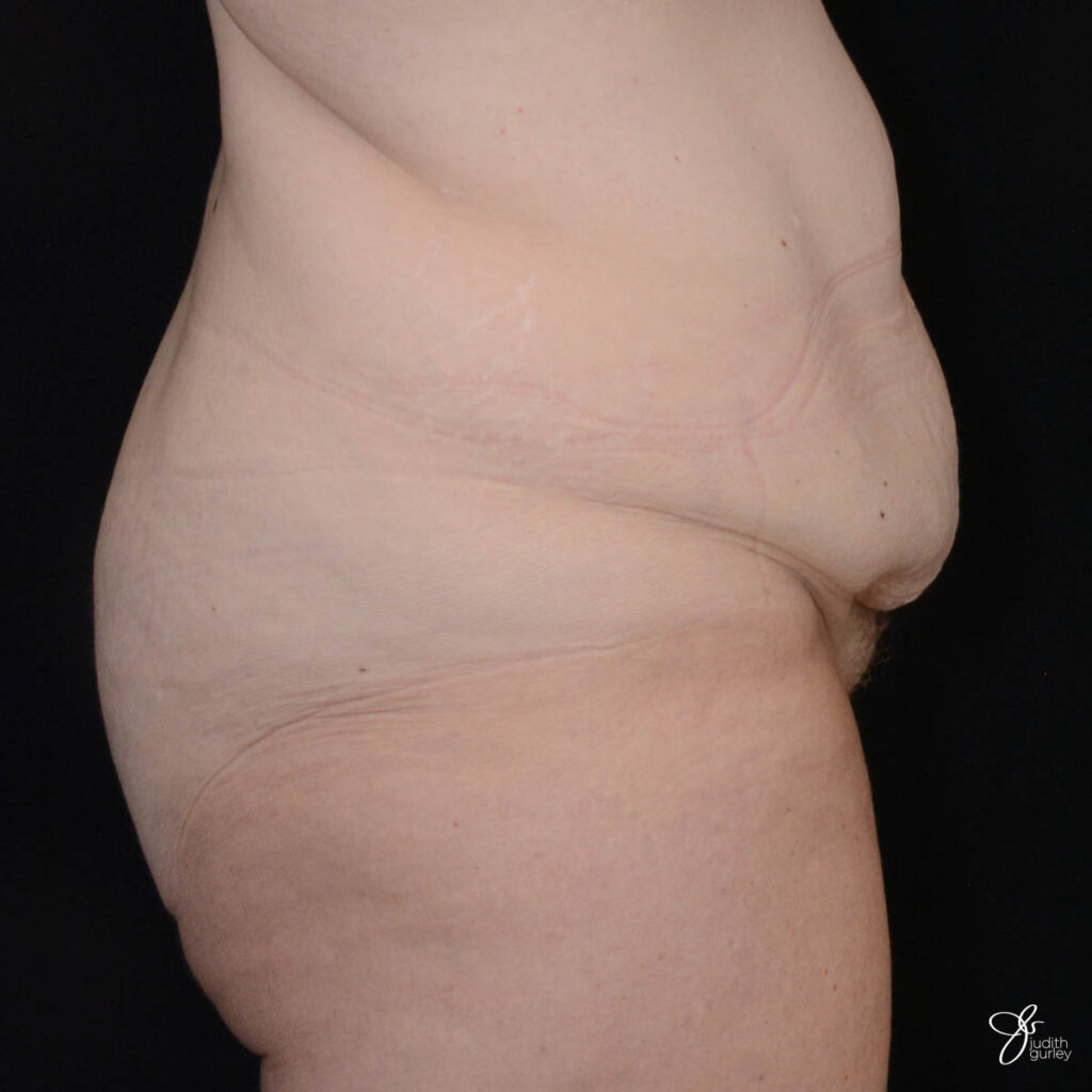 Enlarged & rounded mons pubis 2 years after tummy tuck? (Photo)